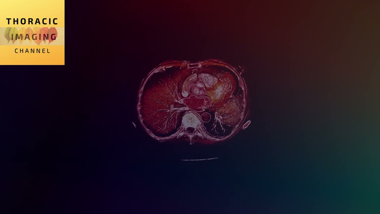 CT evaluation - left atrial bands