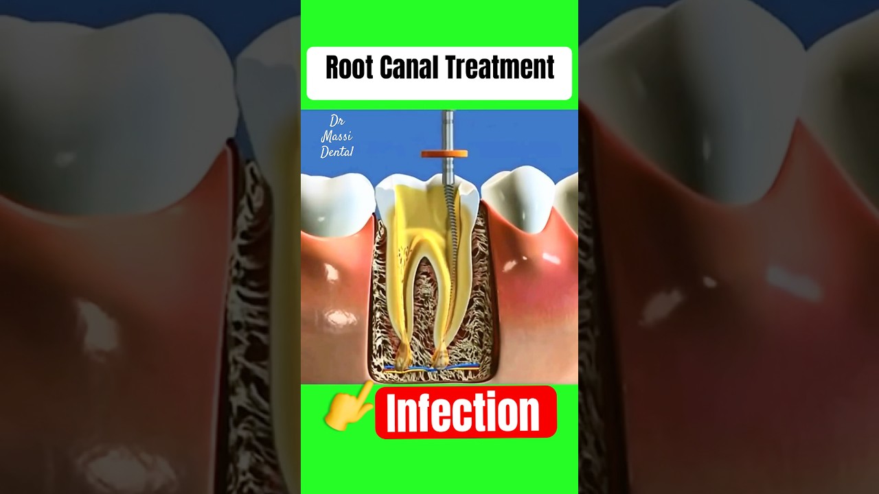 Root Canal Treatment, Infected Tooth Apex