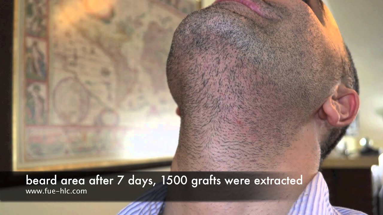 FUE Repair Case With 3500 Grafts Transplant, Hairline Clinic Ankara