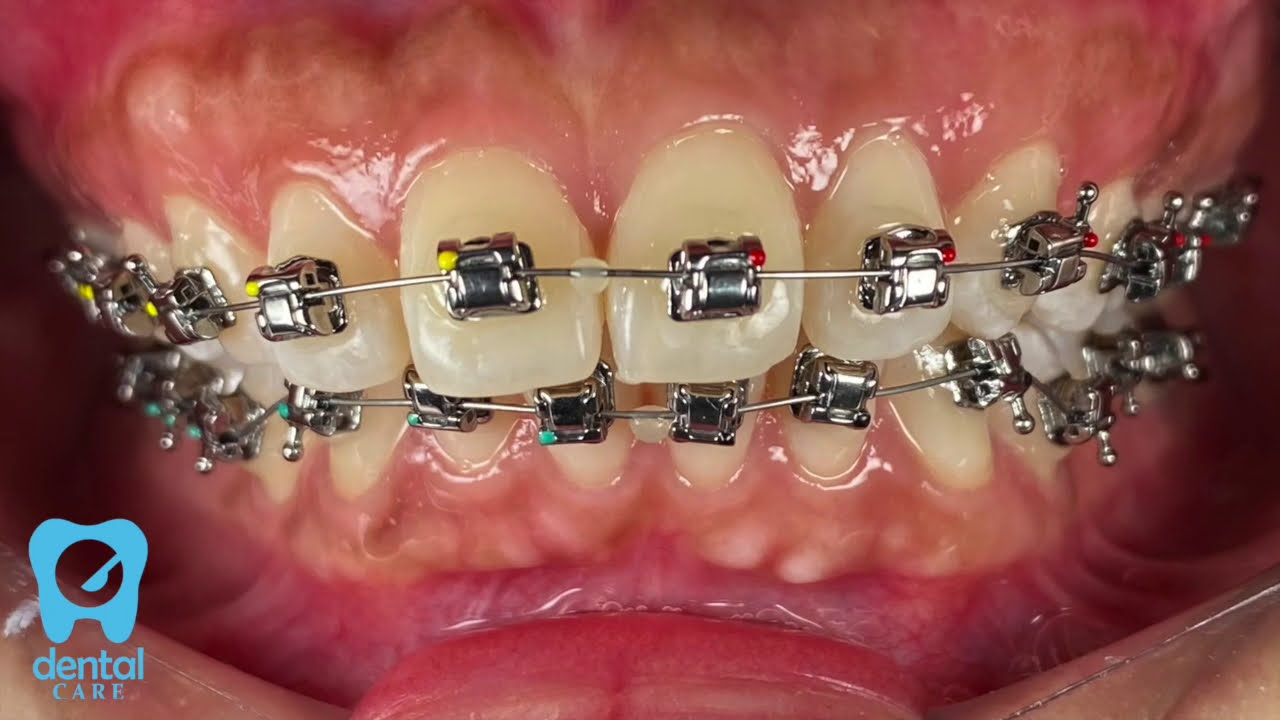 STEP PEMASANGAN BEHEL SELF LIGATING