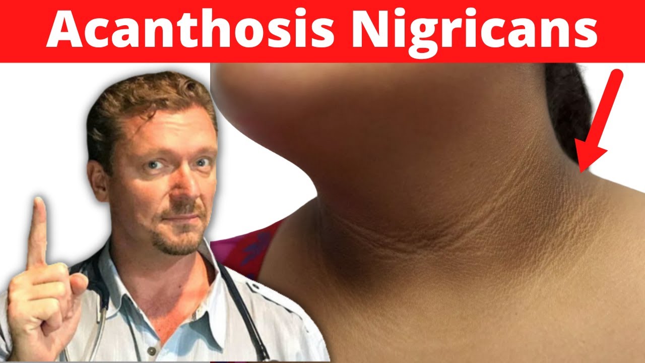 What is Acanthosis Nigricans? (It's NOT Dirty Neck, It's a Sign) Dark Underarms...