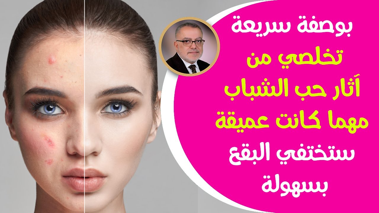 وصفة تبييض البشرة الرائعة والتخلص من حبوب الوجه الملتهبة بشرة أكثر نظافة وناصعة بشكل دائم | حلقـ2ـة