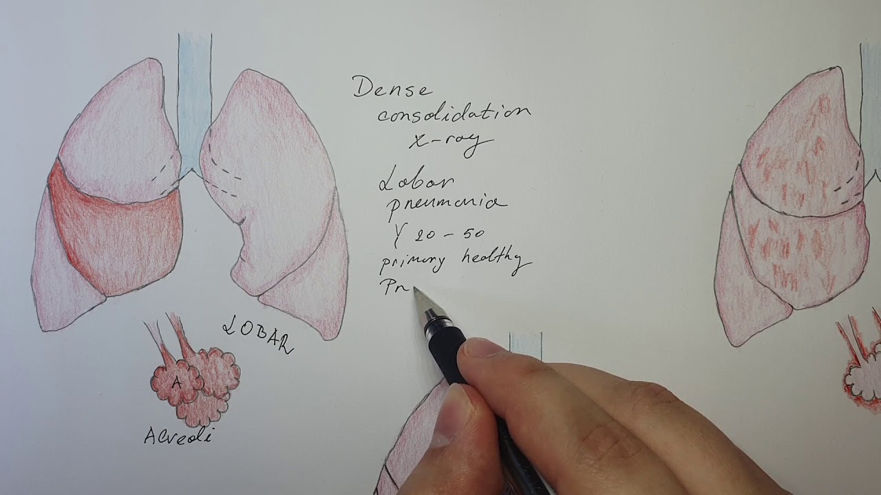 Lobar VS Broncho VS Interstitial pneumonia