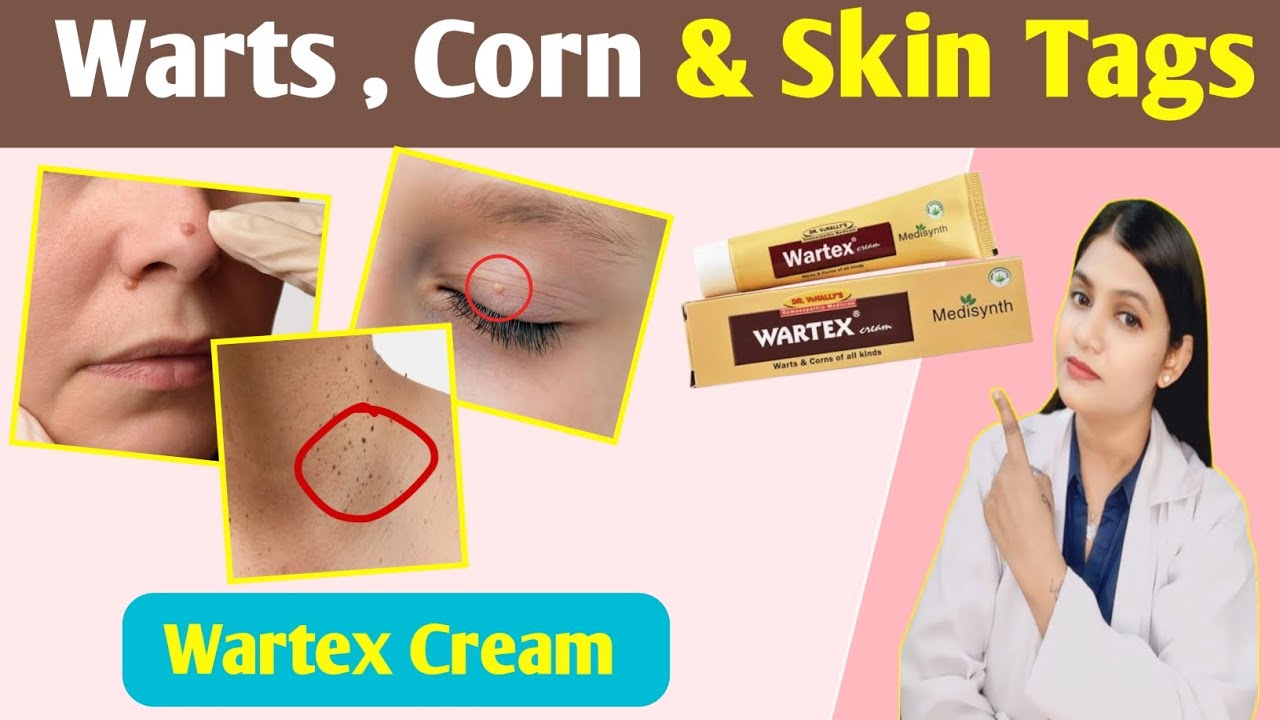 Warts, Corn and Skin Tags removal cream | wartex cream uses for warts removal
