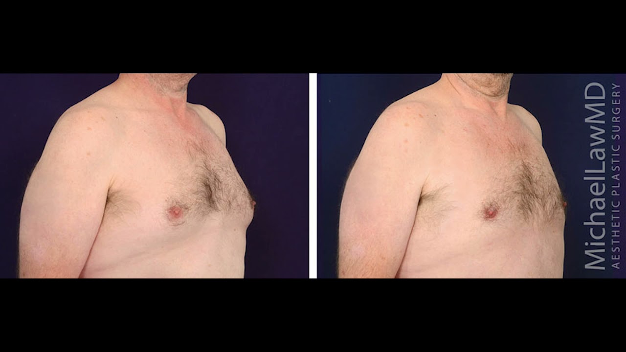 Gynecomastia Surgery Before and After Photos | Gynecomastia by Dr. Law
