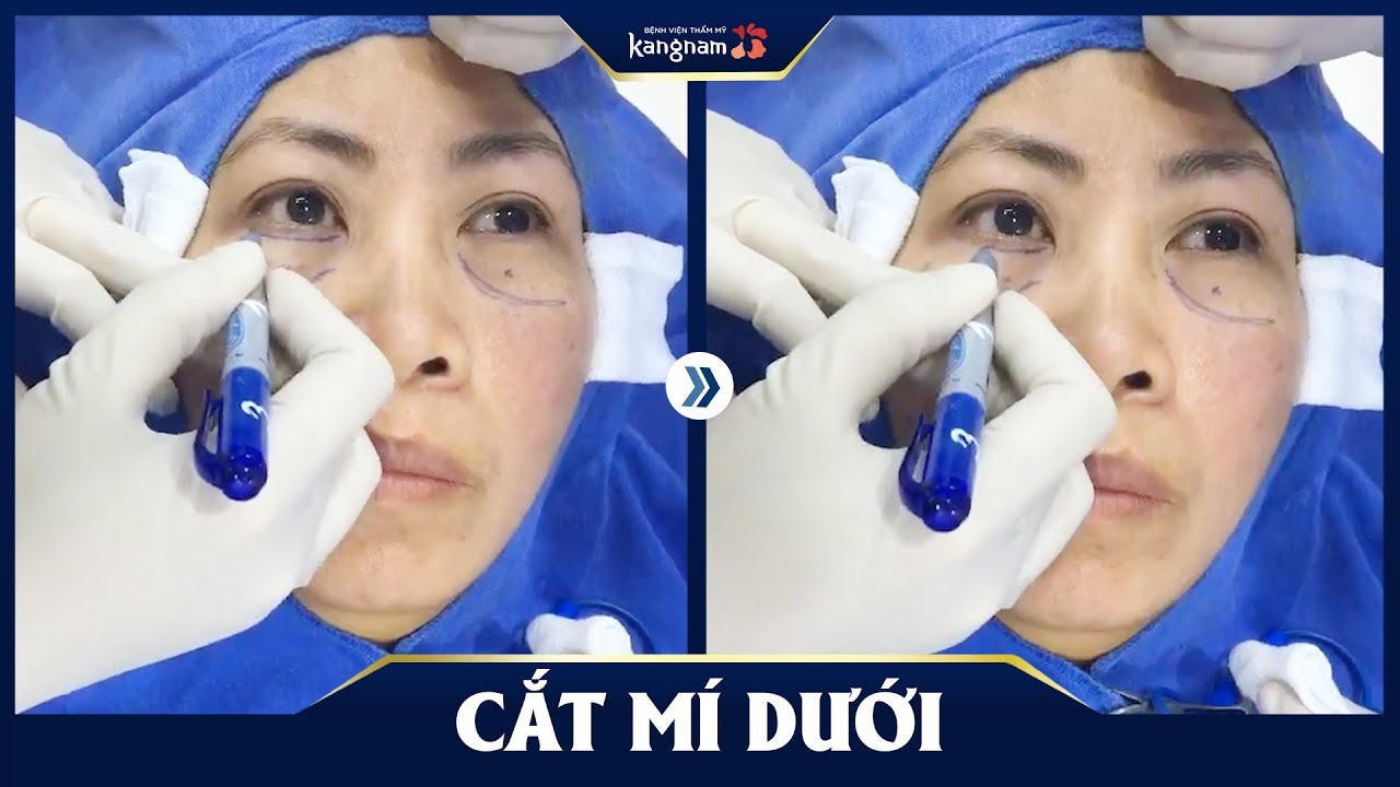 Đo vẽ trước khi Cắt mí mắt dưới + Xóa rãnh lệ tại Kangnam