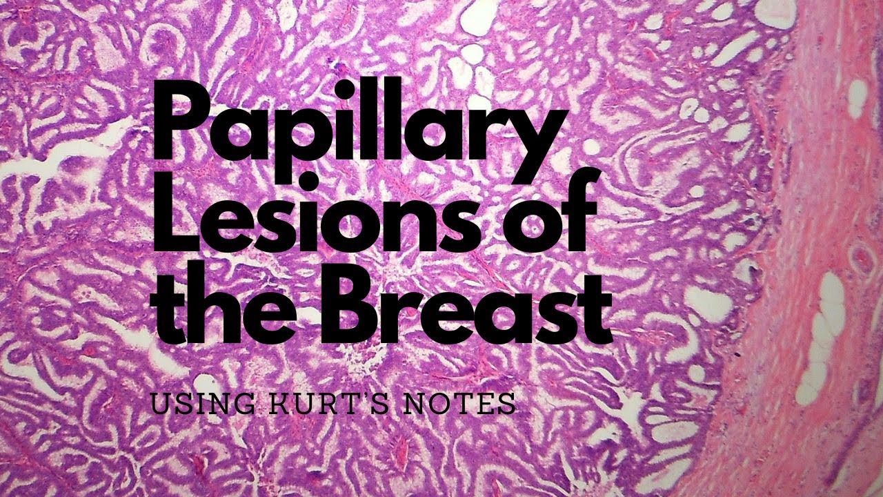 Papillary Breast Lesions:  6 Main Entities using Kurt’s Notes #pathagonia