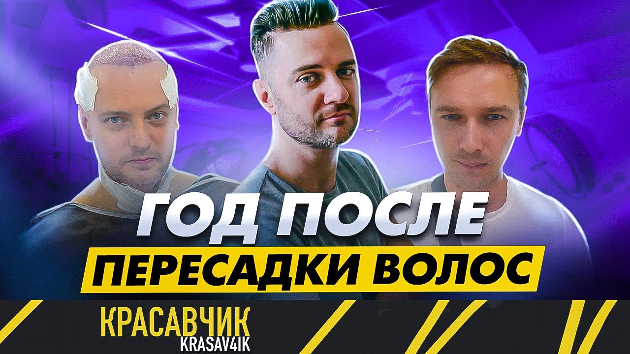 Результаты спустя год после пересадки волос | Насколько твоя жизнь может измениться | KRASAV4IK