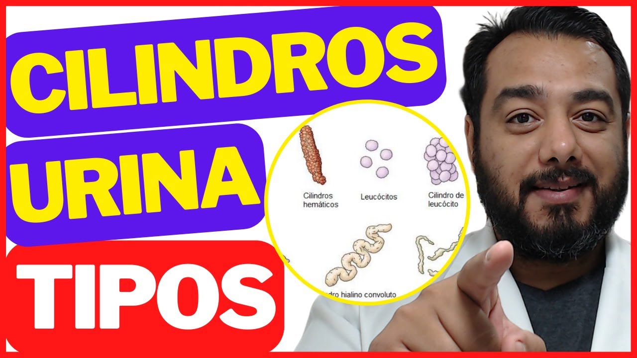 Cilindros na urina: quais os tipos? | Sedimentoscopia | Exame de urina tipo 1 | Urinálise | EAS