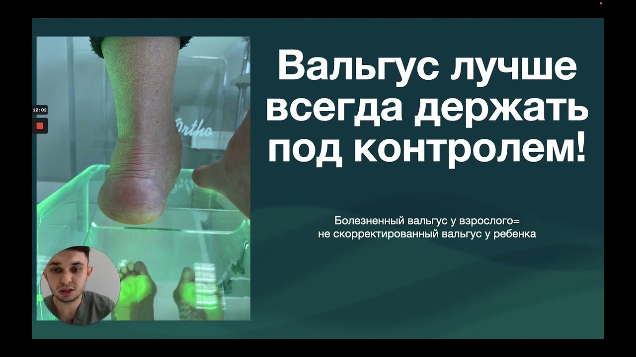 Вальгусная деформация стопы у детей. Современный эффективный подход к лечению