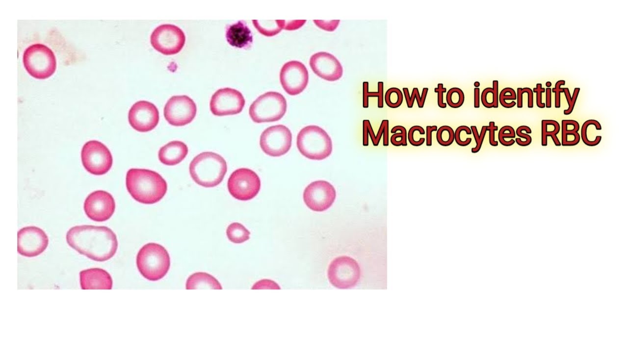Macrocytes RBC