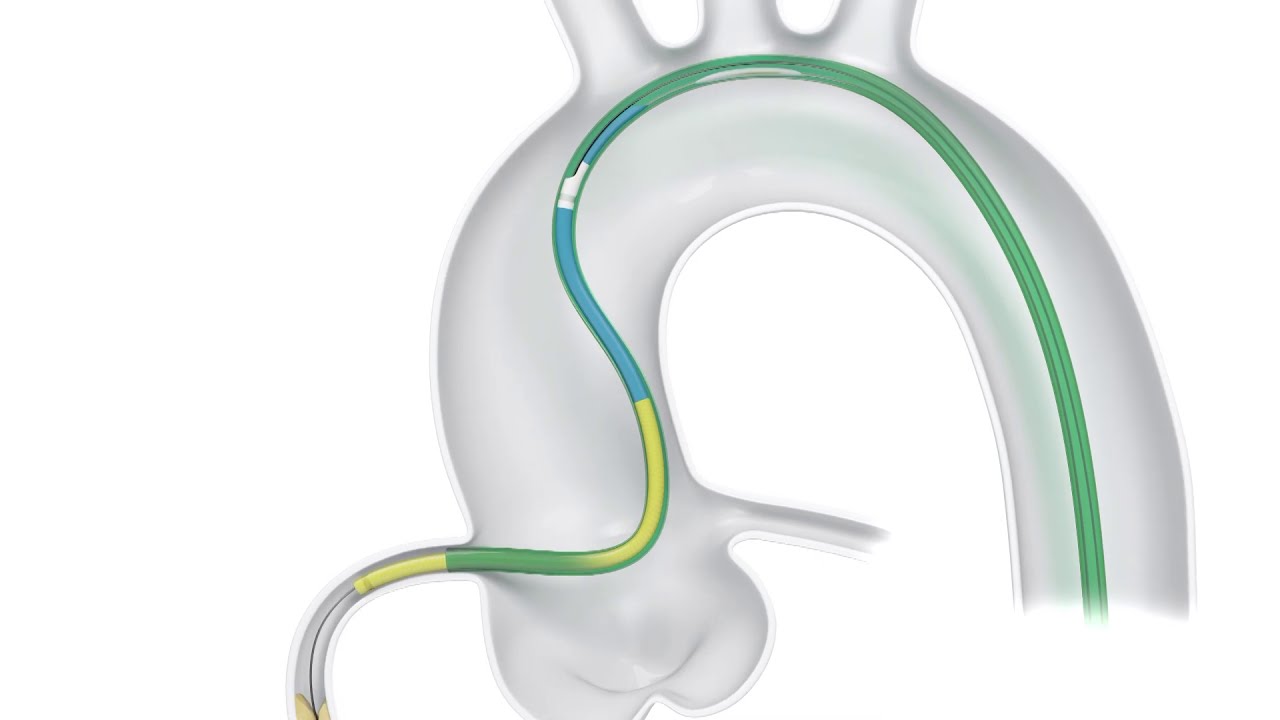 TrapLiner&reg; Catheter Deployment