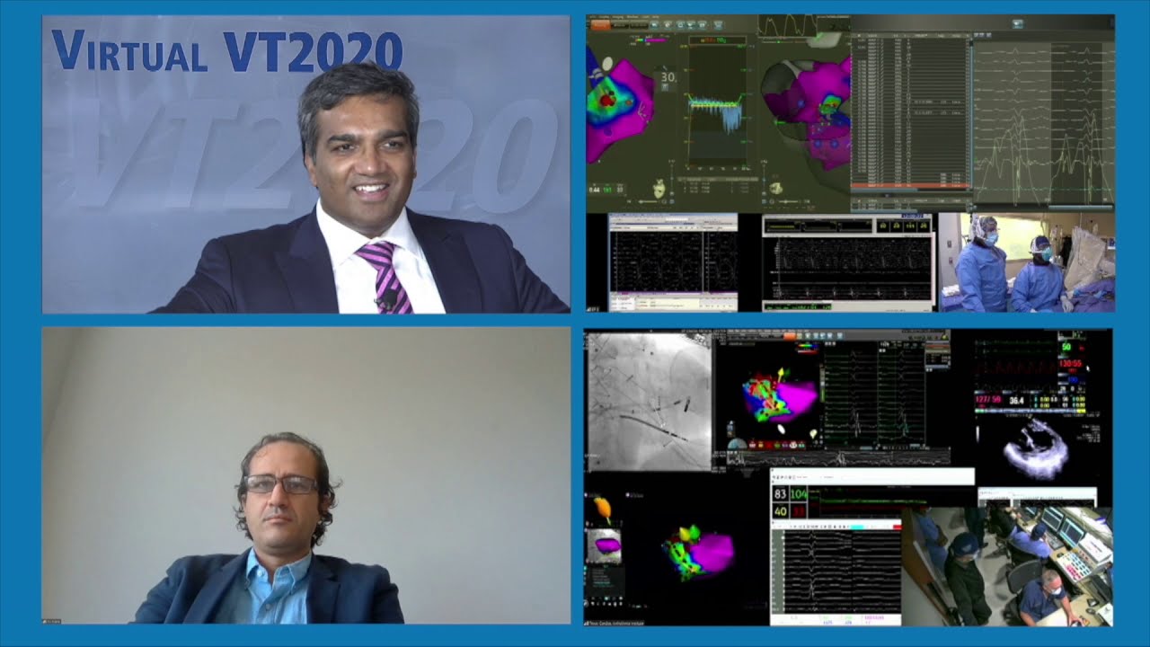 Dr. J David Burkhardt Performs Live Ischemic VT Ablation with Robotic EP at VT Symposium 2020