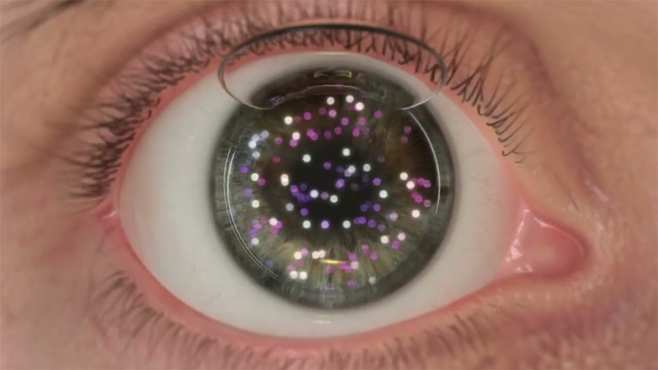 FULL Topography Guided Ablation OVERVIEW Animation