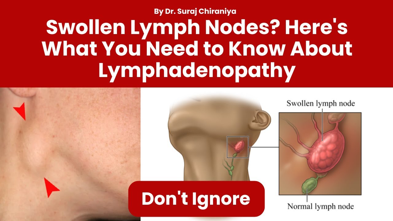 Swollen Lymph Nodes? Here's What You Need to Know About Lymphadenopathy