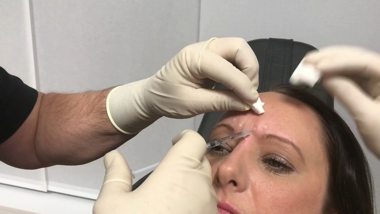 Gesundheitstutorial: Behandlung der Zornesfalte durch Botulinumtoxin