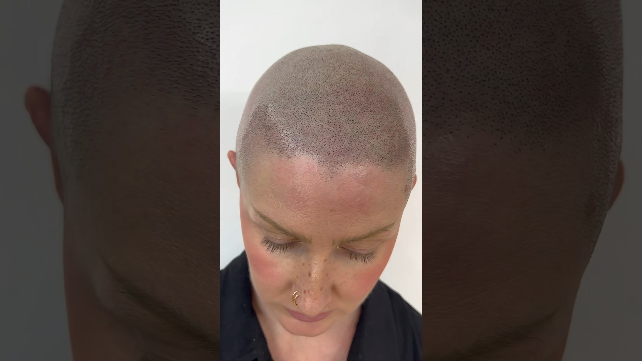 The world&rsquo;s Greatest Women&rsquo;s Hairloss Solution #scalpmicropigmentation
