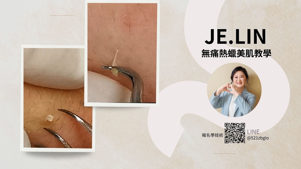 JE無痛清粉刺 青春期粉刺 #林季儀老師 #高雄心怡美顏館  #講師培訓