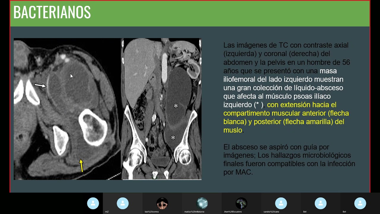 Enfermedades Granulomatosas en Abdomen y Pelvis