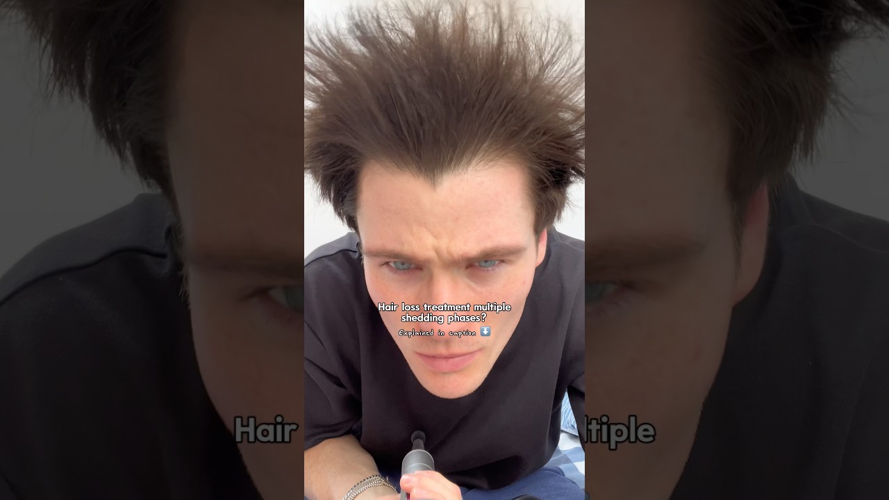 Shedding again on finasteride?