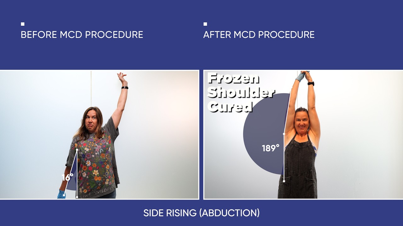 Frozen Shoulder Recovery in 2 Days | Katherine Refused to Lose 2 More Years