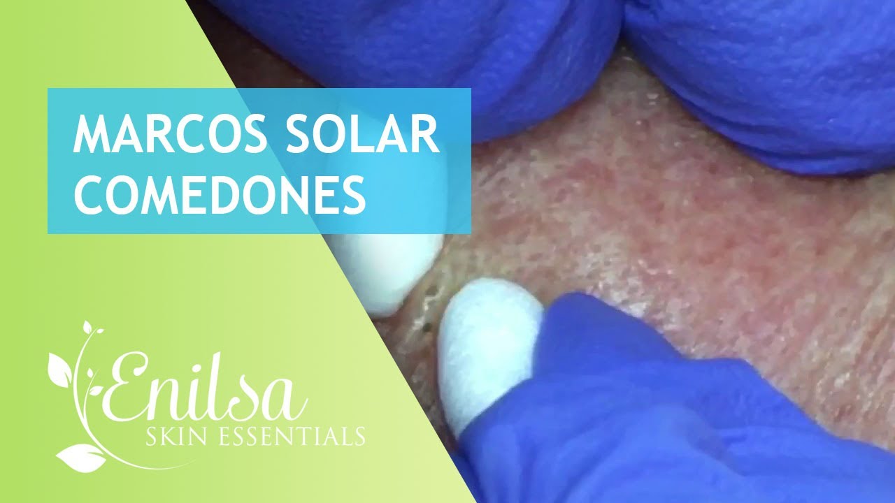Marcos Solar Comedones Extractions