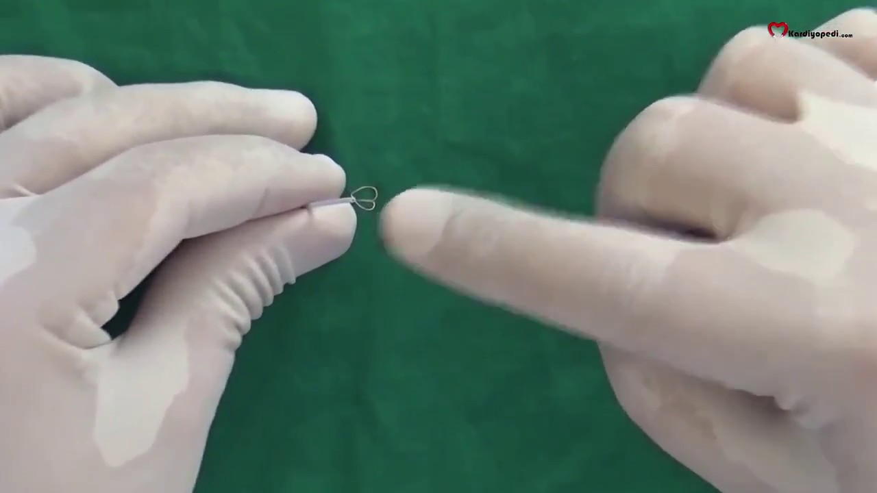 Embolize materyal çıkartılması(snare yöntemi)