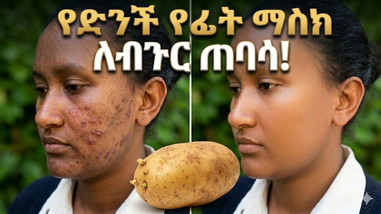 ድንች ለፊት: ጥቅሞች እና ጥንቃቄዎች • #ድንችለፊት• #የፊትእንክብካቤ• #የድንችጠቀሜታ• #ተፈጥሯዊየፊትማስክ• #PotatoFacial• 