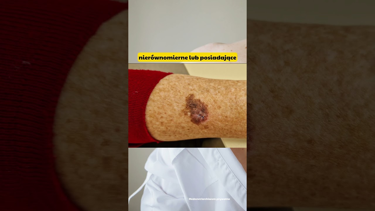 Tak naprawdę wygląda czerniak | Medonet