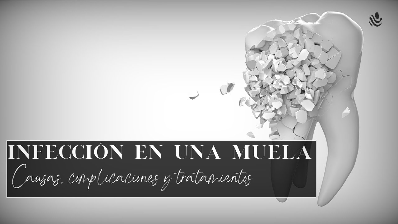 Infección en una muela: Causas, complicaciones y tratamientos