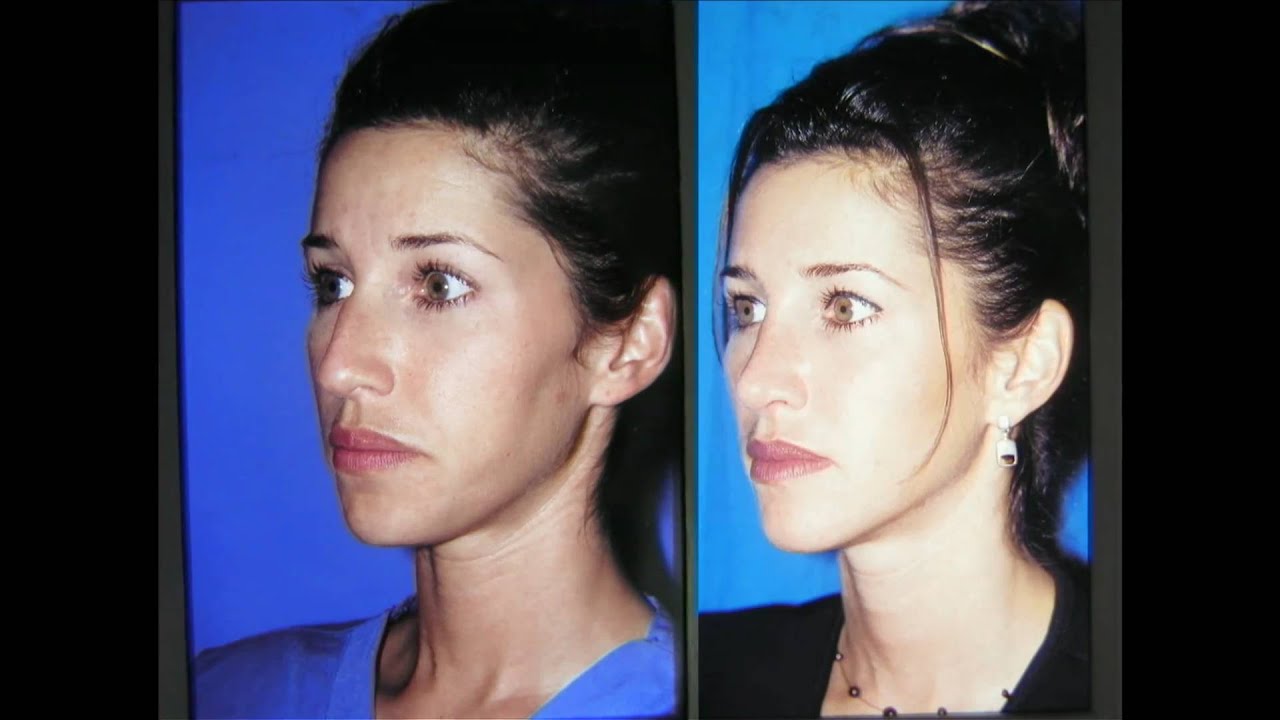 NASHVILLE NASAL (RHINOPLASTY) PLASTIC SURGERY BEFORE AND AFTER