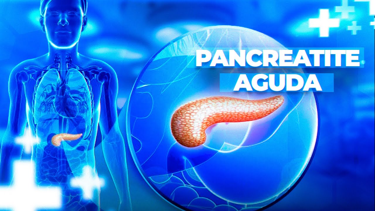 Pancreatite Aguda - Consenso do Colégio Américano de Gastroenterologia!