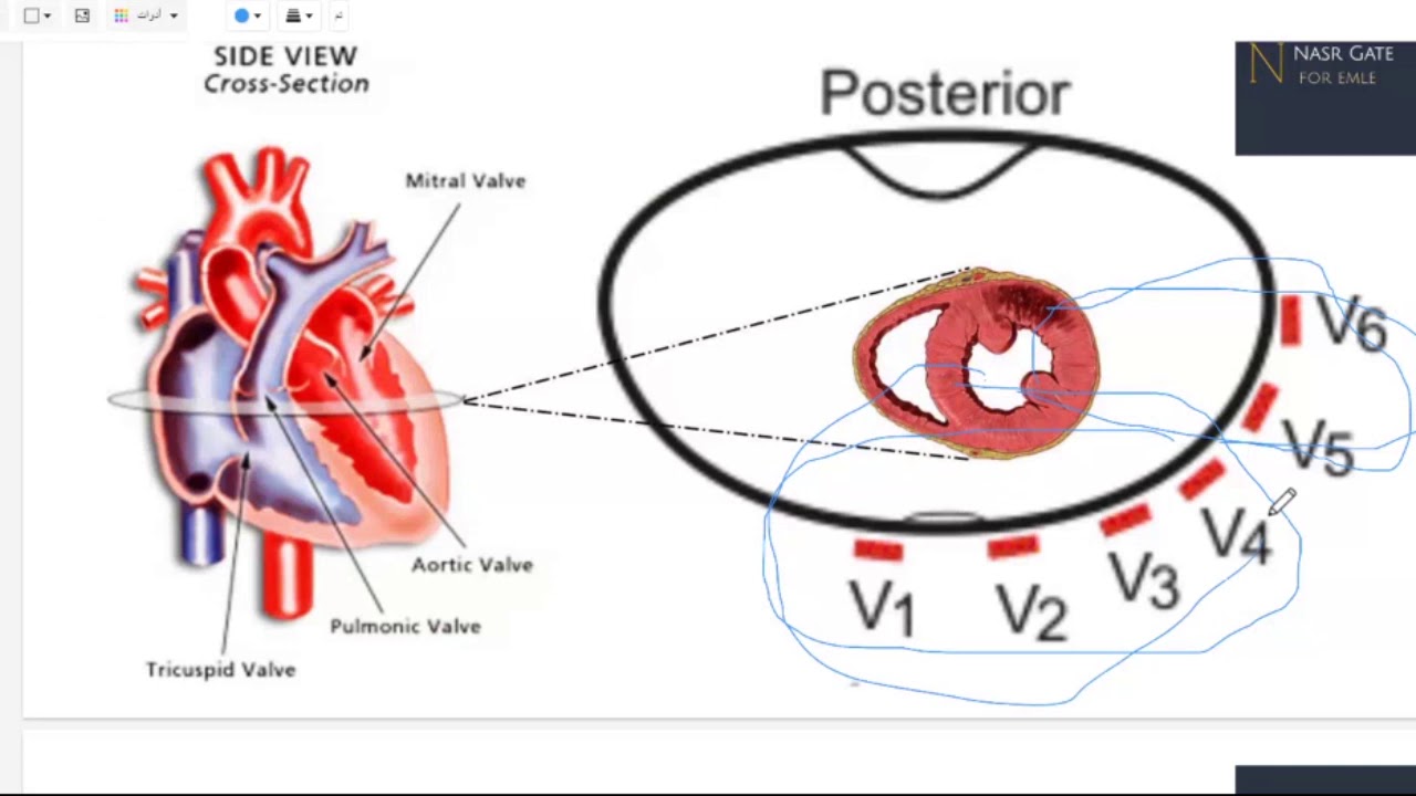 MI     myocardial infarction  in ECG