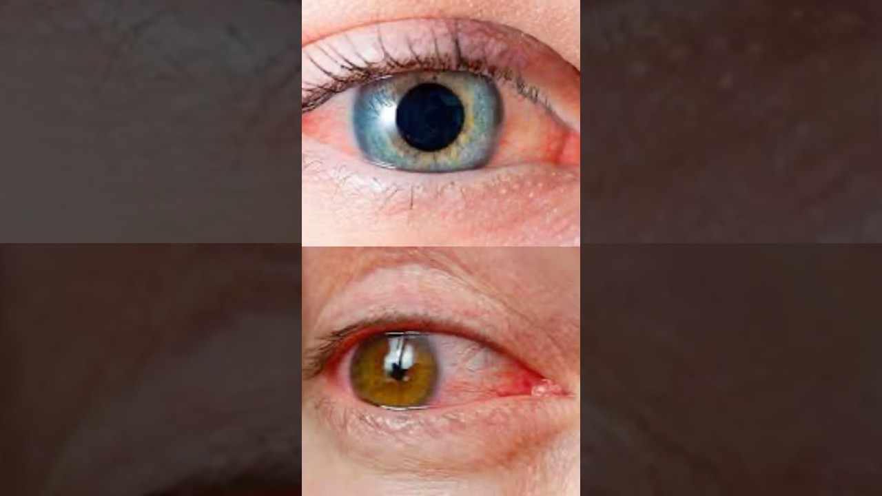 Conjuntivitis viral vs bacteriana | Diferencias clave y tratamiento