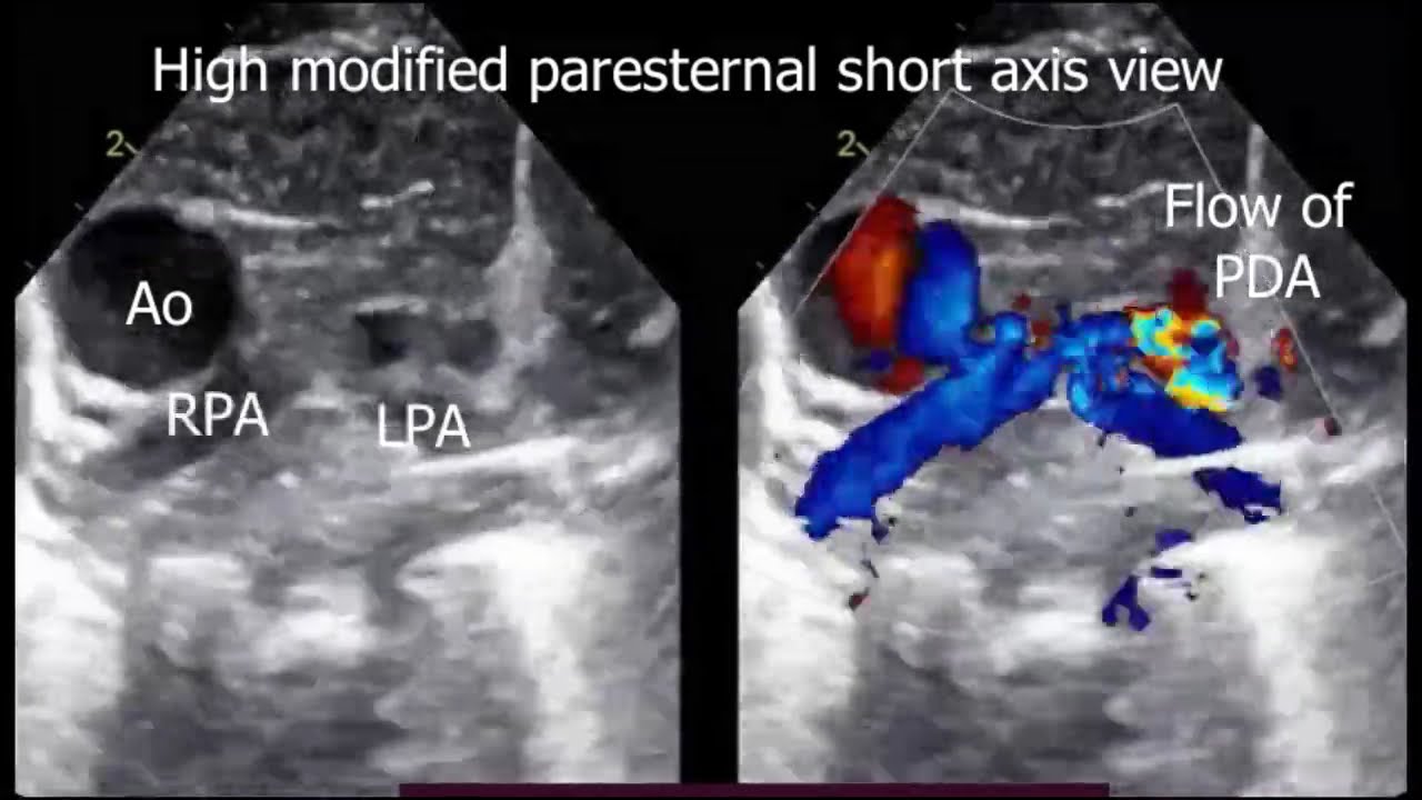 Pulmonary Atresia echo-patterns