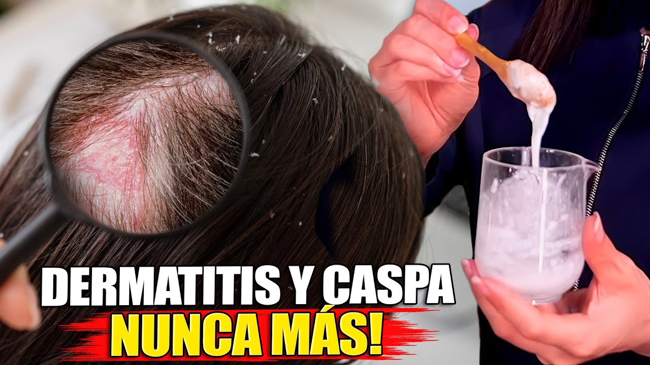 ¡Elimina la DERMATITIS, CASPA y SEBORREA! Receta Rápida y Casera.