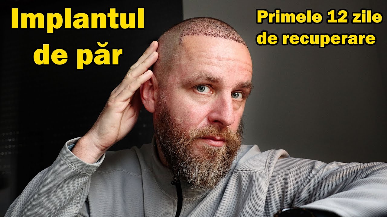 Recuperarea după Implantul de Păr: Primele 12 Zile – La ce să te Aștepți!