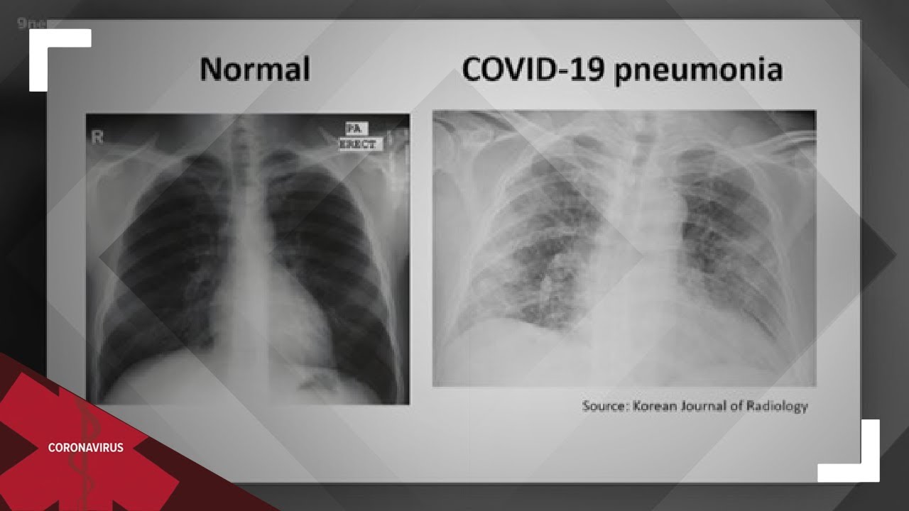 Progression of COVID-19 infection