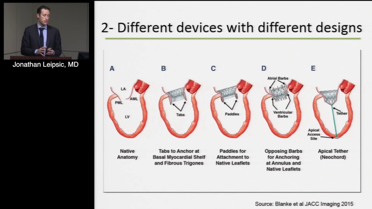 CT for Transcatheter Mitral and Tricuspid Interventions (Jonathan Leipsic, MD) March 16, 2017