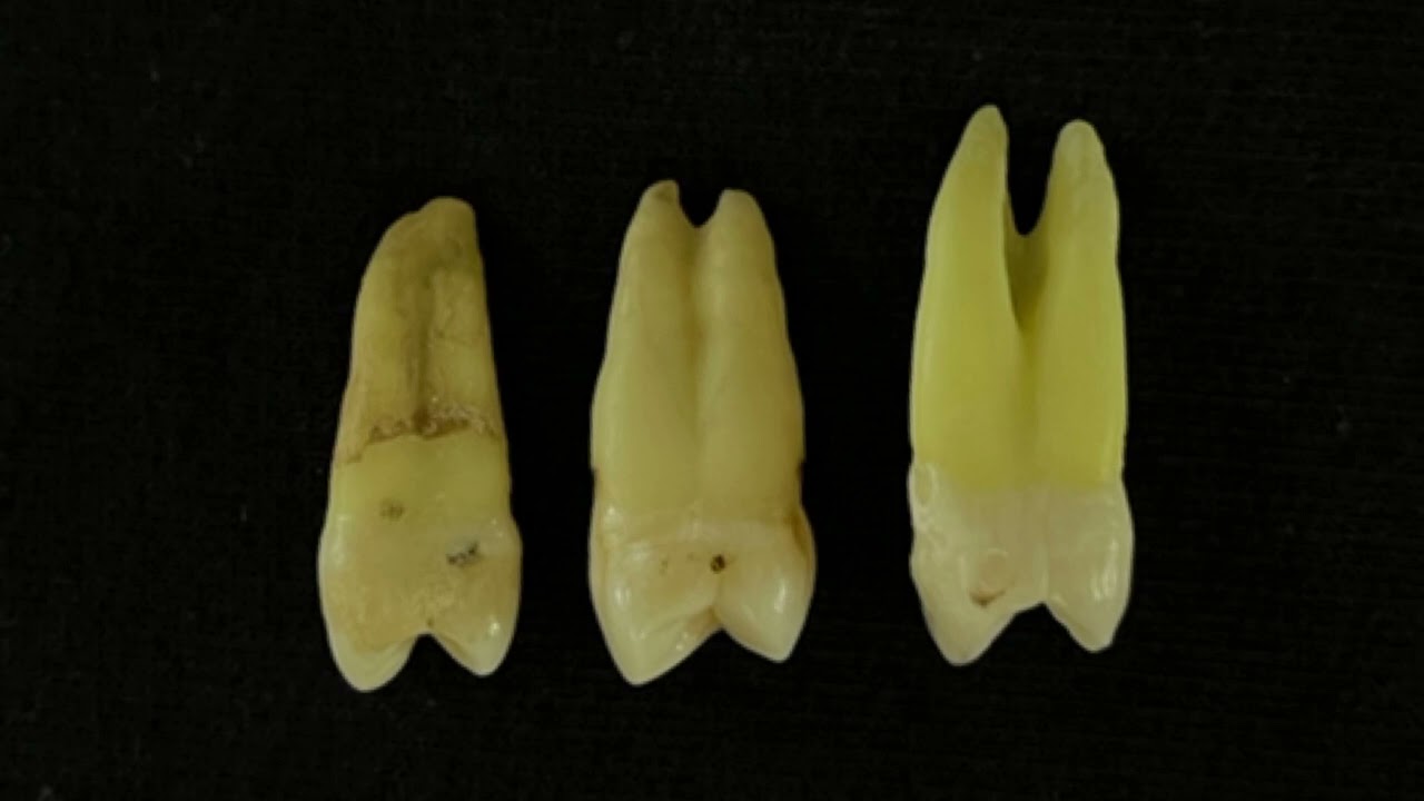 PULP MORPHOLOGY OF MAXILLARY PREMOLARS