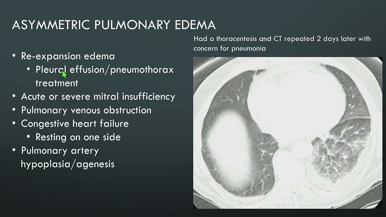 Introduction to HRCT: Septal Line Thickening and Crazy Paving