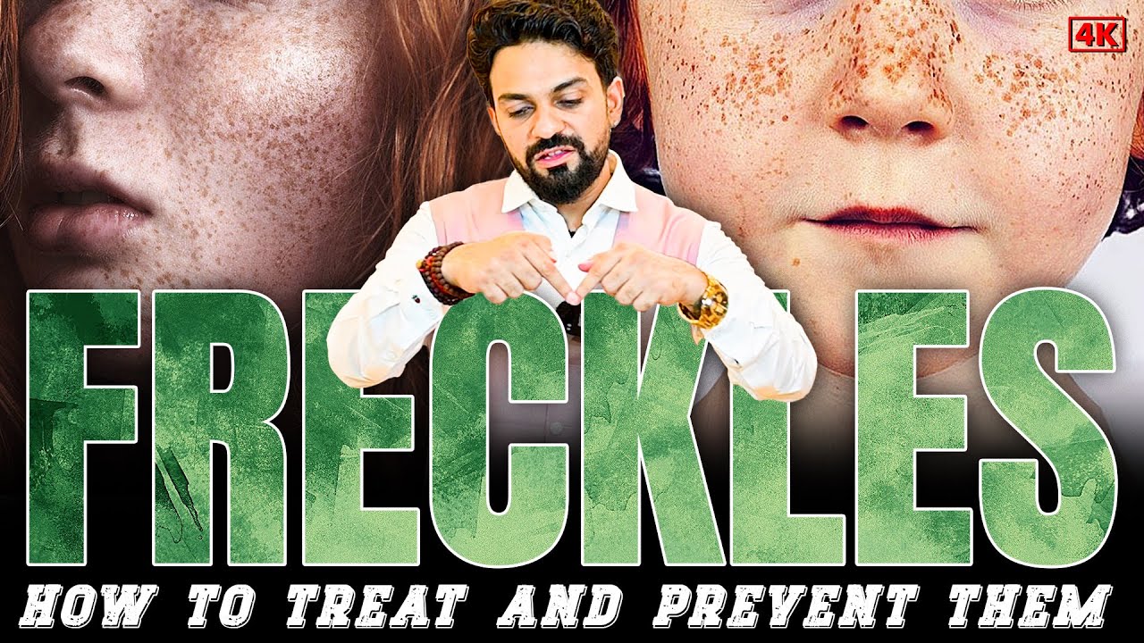 Freckles क्या होता हैं ? चेहरे पर तिल दाग धब्बे से कैसे पाए छुटकारा - Dr.Lalit Kasana's