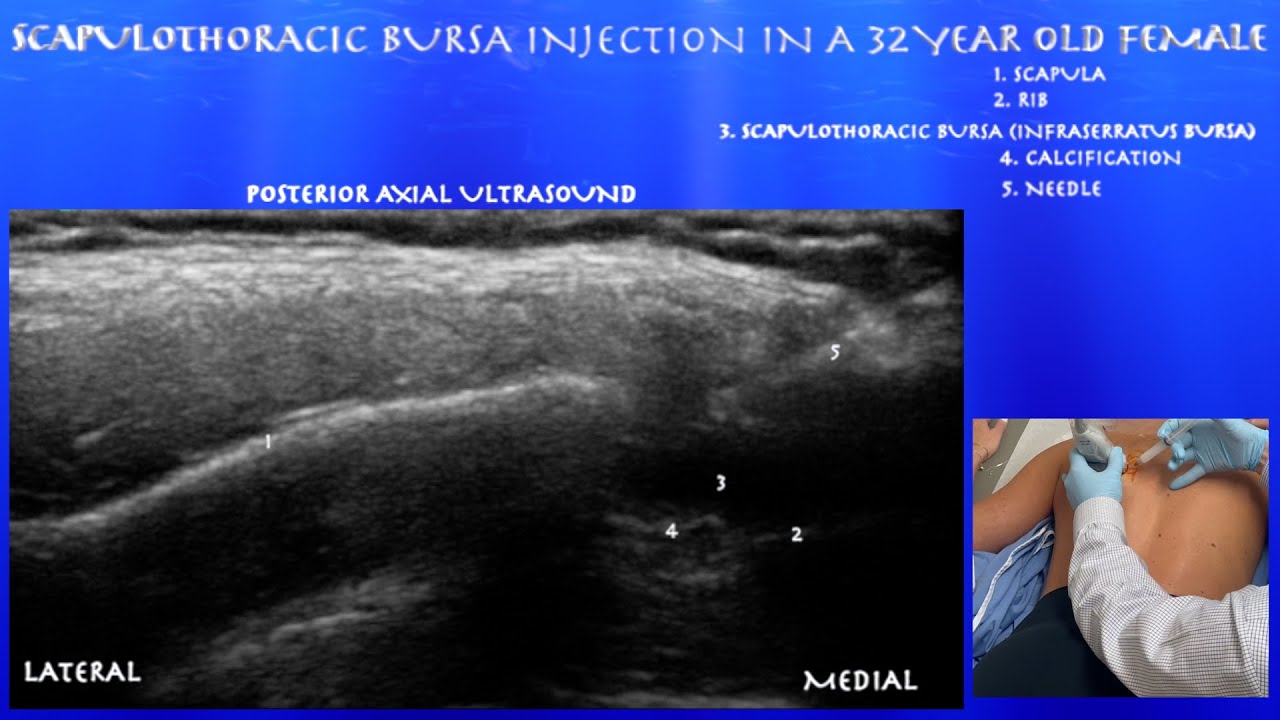 Ultrasound guided Scapulothoracic Bursitis Injection--in a 32 Year Old Female with Revised Model
