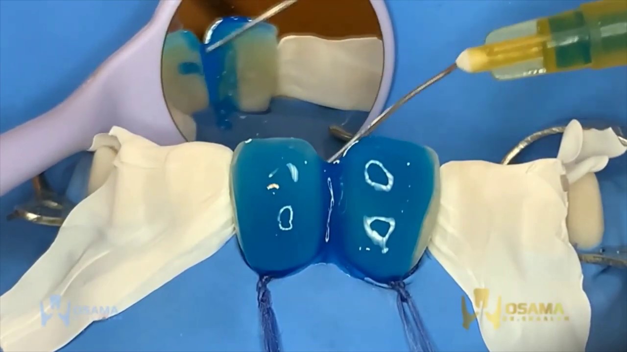 diastema closure with composite resin