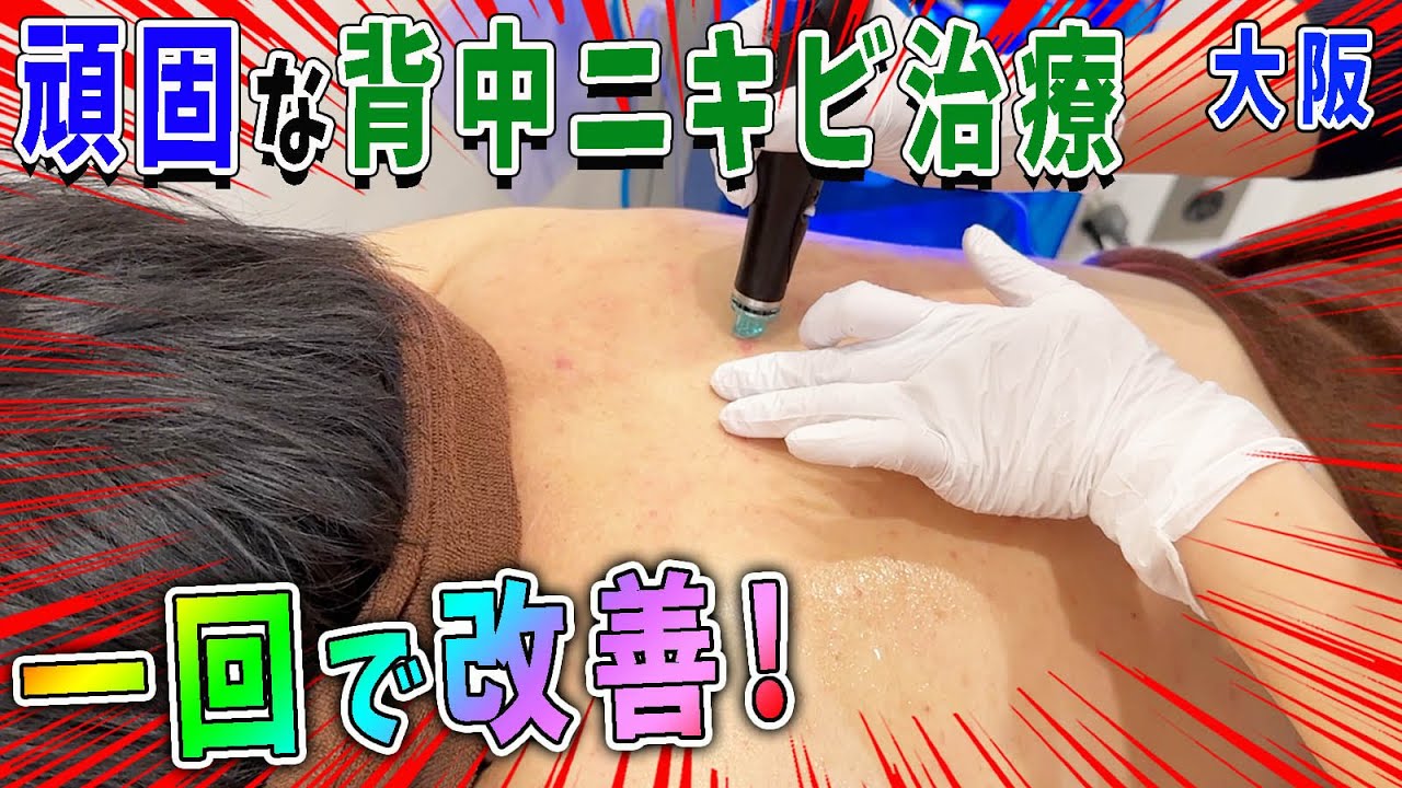 【ニキビ治療】にゅるにゅる出る背中ストレスニキビを大阪のクリニックでスッキリ治療！とんでもない汚れが出た！