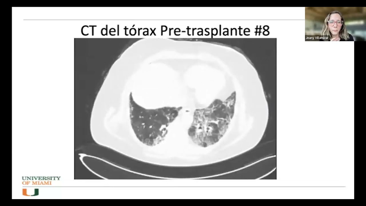 Webinar Trasplante Pulmonar 12 oct 2023