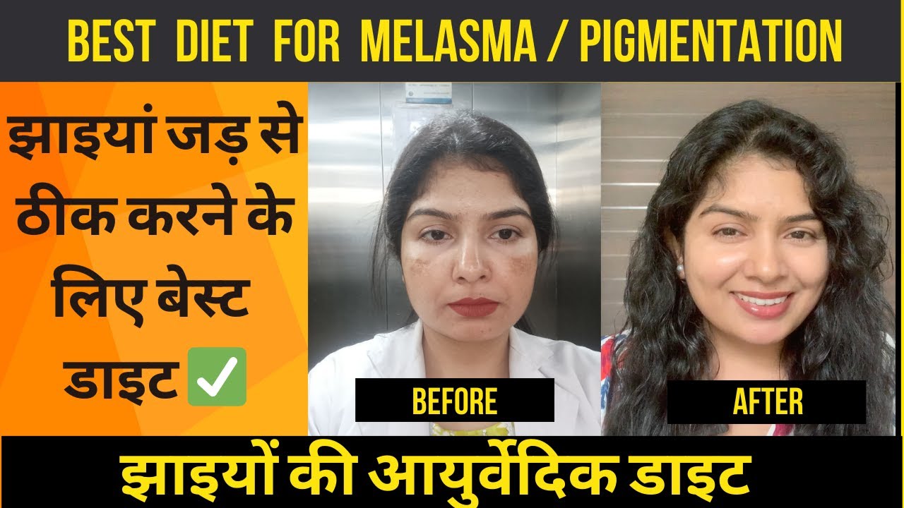 MELASMA DIET | DIET FOR MELASMA | DIET FOR PIGMENTATION | झाइयों KE LIYE DIET