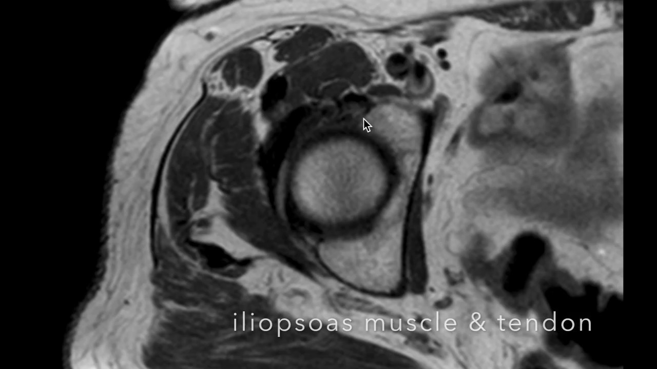 Snapping Hip Syndrome