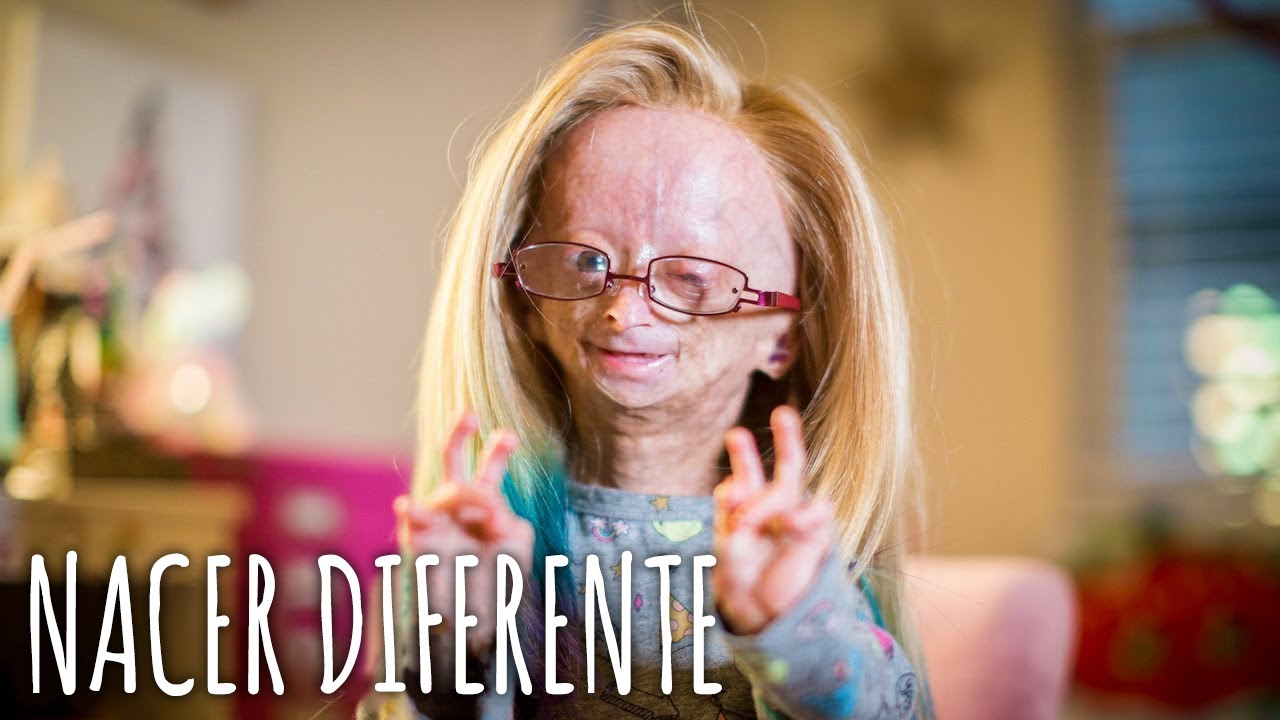 Soy Adalia y Envejezco Demasiado Rápido | Nacimos Diferentes | truly en español
