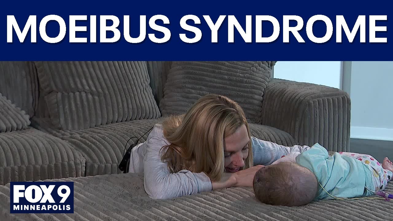 9-month-old baby with rare condition can’t blink or smile